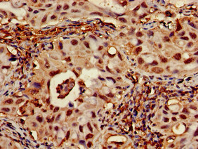 RPA70 / RPA1 Antibody - Immunohistochemistry of paraffin-embedded human lung cancer using RPA1 Antibody at dilution of 1:100
