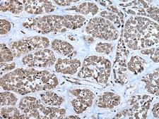 RPF2 / BXDC1 Antibody - Immunohistochemistry of paraffin-embedded Human esophagus cancer tissue  using RPF2 Polyclonal Antibody at dilution of 1:40(×200)