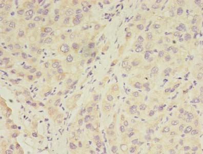 RPGR Antibody - Immunohistochemistry of paraffin-embedded human liver cancer using antibody at dilution of 1:100.