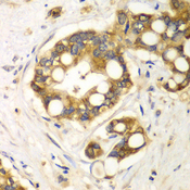 RPH3A / Rabphilin 3A Antibody - Immunohistochemistry of paraffin-embedded human liver cancer tissue.