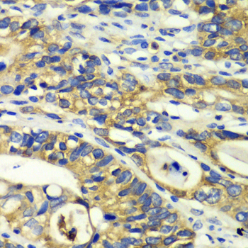 RPH3A / Rabphilin 3A Antibody - Immunohistochemistry of paraffin-embedded human colon carcinoma tissue.