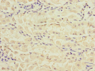 RPIA / RPI Antibody - Immunohistochemistry of paraffin-embedded human gastric cancer at dilution 1:100