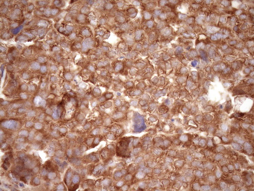 RPL10 / Ribosomal Protein L10 Antibody - Immunohistochemical staining of paraffin-embedded Adenocarcinoma of Human ovary tissue using anti-RPL10 mouse monoclonal antibody. (Heat-induced epitope retrieval by Tris-EDTA, pH8.0)(1:150)