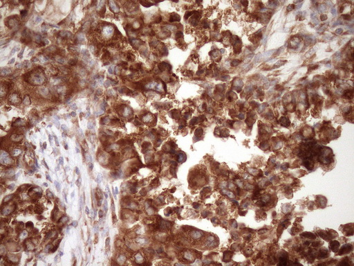 RPL10 / Ribosomal Protein L10 Antibody - Immunohistochemical staining of paraffin-embedded Adenocarcinoma of Human endometrium tissue using anti-RPL10 mouse monoclonal antibody. (Heat-induced epitope retrieval by Tris-EDTA, pH8.0)(1:150)