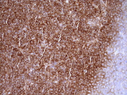 RPL10 / Ribosomal Protein L10 Antibody - Immunohistochemical staining of paraffin-embedded Human lymphoma tissue using anti-RPL10 mouse monoclonal antibody. (Heat-induced epitope retrieval by Tris-EDTA, pH8.0)(1:150)