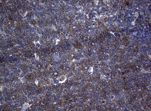 RPL10 / Ribosomal Protein L10 Antibody - Immunohistochemical staining of paraffin-embedded Human lymphoma tissue using anti-RPL10 mouse monoclonal antibody. (Heat-induced epitope retrieval by 1mM EDTA in 10mM Tris buffer. (pH8.5) at 120°C for 3 min. (1:150)