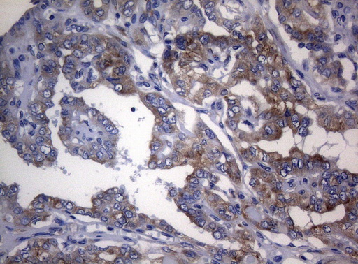 RPL10 / Ribosomal Protein L10 Antibody - Immunohistochemical staining of paraffin-embedded Carcinoma of Human thyroid tissue using anti-RPL10 mouse monoclonal antibody. (Heat-induced epitope retrieval by 1mM EDTA in 10mM Tris buffer. (pH8.5) at 120°C for 3 min. (1:150)