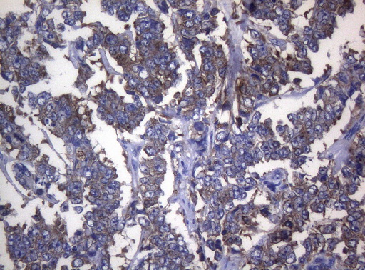 RPL10 / Ribosomal Protein L10 Antibody - Immunohistochemical staining of paraffin-embedded Adenocarcinoma of Human endometrium tissue using anti-RPL10 mouse monoclonal antibody. (Heat-induced epitope retrieval by 1mM EDTA in 10mM Tris buffer. (pH8.5) at 120°C for 3 min. (1:150)