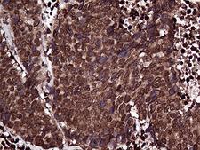 RPL10A Antibody - Immunohistochemical staining of paraffin-embedded Carcinoma of Human lung tissue using anti-RPL10A mouse monoclonal antibody. (Heat-induced epitope retrieval by 1mM EDTA in 10mM Tris buffer. (pH8.5) at 120°C for 3 min. (1:2000)