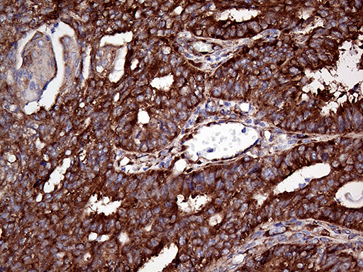 RPL10A Antibody - Immunohistochemical staining of paraffin-embedded Adenocarcinoma of Human endometrium tissue using anti-RPL10A mouse monoclonal antibody. (Heat-induced epitope retrieval by 1mM EDTA in 10mM Tris buffer. (pH8.5) at 120°C for 3 min. (1:2000)