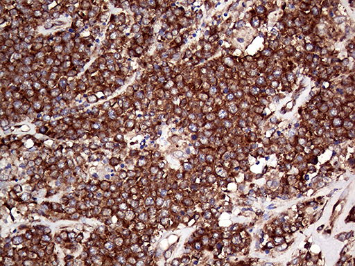 RPL10A Antibody - Immunohistochemical staining of paraffin-embedded Human lymphoma tissue using anti-RPL10A mouse monoclonal antibody. (Heat-induced epitope retrieval by 1mM EDTA in 10mM Tris buffer. (pH8.5) at 120°C for 3 min. (1:2000)
