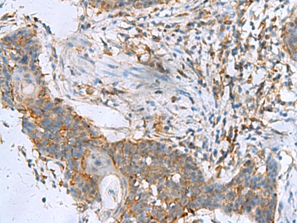 RPL10A Antibody - Immunohistochemistry of paraffin-embedded Human esophagus cancer tissue  using RPL10A Polyclonal Antibody at dilution of 1:50(×200)