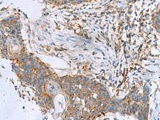 RPL10A Antibody - Immunohistochemistry of paraffin-embedded Human esophagus cancer tissue  using RPL10A Polyclonal Antibody at dilution of 1:50(×200)