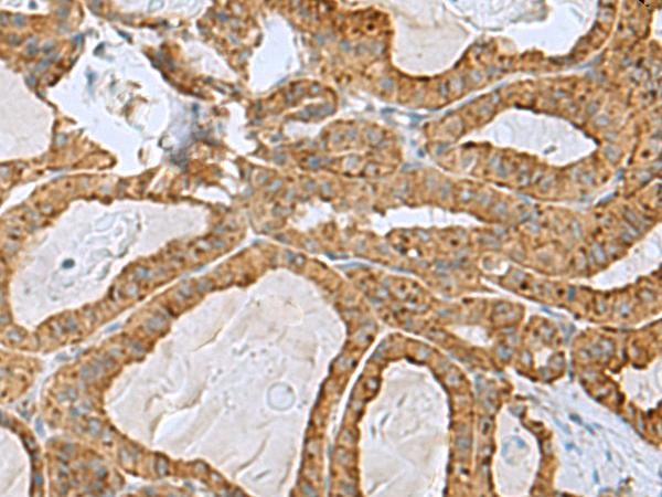 RPL10A Antibody - Immunohistochemistry of paraffin-embedded Human thyroid cancer tissue  using RPL10A Polyclonal Antibody at dilution of 1:50(×200)