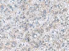RPL10A Antibody - Immunohistochemistry of paraffin-embedded Human liver cancer tissue  using RPL10A Polyclonal Antibody at dilution of 1:50(×200)