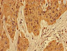RPL10L Antibody - Immunohistochemistry of paraffin-embedded human cervical cancer using RPL10L Antibody at dilution of 1:100