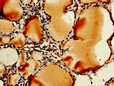 RPL11 / Ribosomal Protein L11 Antibody - IHC image of RPL11 Antibody diluted at 1:250 and staining in paraffin-embedded human thyroid tissue performed on a Leica BondTM system. After dewaxing and hydration, antigen retrieval was mediated by high pressure in a citrate buffer (pH 6.0). Section was blocked with 10% normal goat serum 30min at RT. Then primary antibody (1% BSA) was incubated at 4°C overnight. The primary is detected by a biotinylated secondary antibody and visualized using an HRP conjugated SP system.