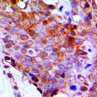 RPL13 / Ribosomal Protein L13 Antibody - Immunohistochemical analysis of RPL13 staining in human breast cancer formalin fixed paraffin embedded tissue section. The section was pre-treated using heat mediated antigen retrieval with sodium citrate buffer (pH 6.0). The section was then incubated with the antibody at room temperature and detected using an HRP conjugated compact polymer system. DAB was used as the chromogen. The section was then counterstained with hematoxylin and mounted with DPX.