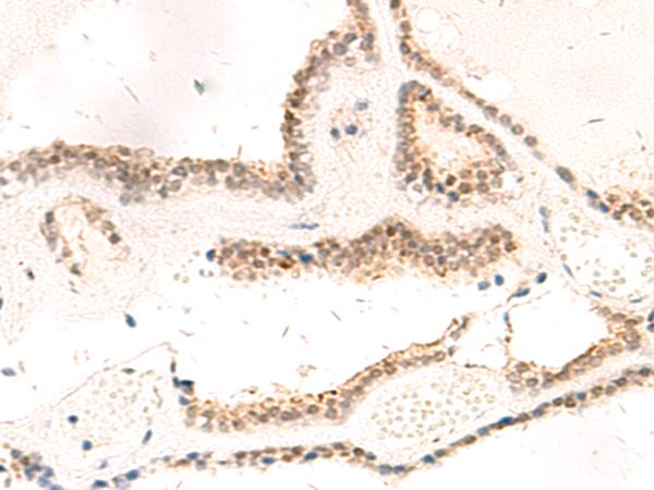 RPL13A Antibody - Immunohistochemistry of paraffin-embedded Human thyroid cancer tissue  using RPL13A Polyclonal Antibody at dilution of 1:95(×200)
