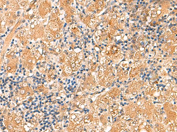 RPL13A Antibody - Immunohistochemistry of paraffin-embedded Human liver cancer tissue  using RPL13A Polyclonal Antibody at dilution of 1:60(×200)