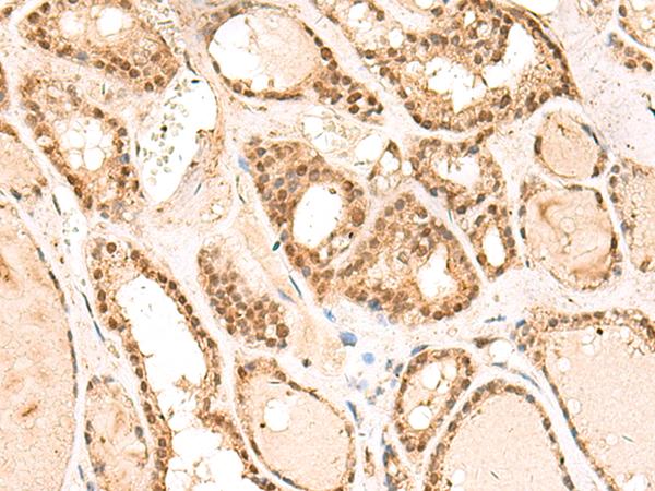 RPL13A Antibody - Immunohistochemistry of paraffin-embedded Human thyroid cancer tissue  using RPL13A Polyclonal Antibody at dilution of 1:60(×200)
