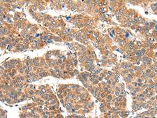 RPL14 / Ribosomal Protein L14 Antibody - Immunohistochemistry of paraffin-embedded Human liver cancer tissue  using RPL14 Polyclonal Antibody at dilution of 1:30(×200)