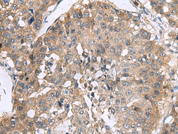 RPL18 / Ribosomal Protein L18 Antibody - Immunohistochemistry of paraffin-embedded Human liver cancer tissue  using RPL18 Polyclonal Antibody at dilution of 1:70(×200)
