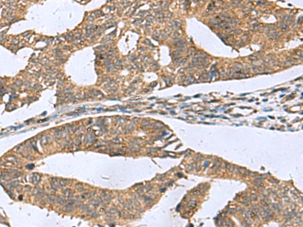 RPL18 / Ribosomal Protein L18 Antibody - Immunohistochemistry of paraffin-embedded Human colorectal cancer tissue  using RPL18 Polyclonal Antibody at dilution of 1:70(×200)