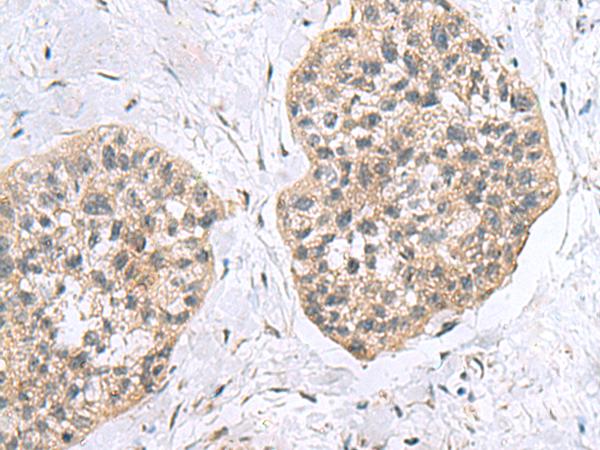 RPL18 / Ribosomal Protein L18 Antibody - Immunohistochemistry of paraffin-embedded Human esophagus cancer tissue  using RPL18 Polyclonal Antibody at dilution of 1:60(×200)