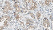 RPL18A Antibody - 1:100 staining human prostate tissue by IHC-P. The sample was formaldehyde fixed and a heat mediated antigen retrieval step in citrate buffer was performed. The sample was then blocked and incubated with the antibody for 1.5 hours at 22°C. An HRP conjugated goat anti-rabbit antibody was used as the secondary.