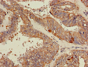RPL19 / Ribosomal Protein L19 Antibody - Immunohistochemistry of paraffin-embedded human endometrial cancer using RPL19 Antibody at dilution of 1:100