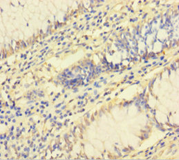 RPL26L1 Antibody - Immunohistochemistry of paraffin-embedded human colon cancer using RPL26L1 Antibody at dilution of 1:100