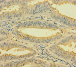 RPL26L1 Antibody - Immunohistochemistry of paraffin-embedded human endometrial cancer using RPL26L1 Antibody at dilution of 1:100