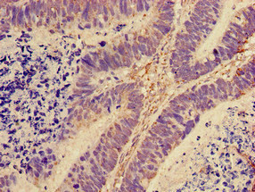 RPL28 / Ribosomal Protein L28 Antibody - Immunohistochemistry of paraffin-embedded human ovarian cancer using RPL28 Antibody, Biotin conjugated at dilution of 1:100