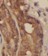 RPL29 / Ribosomal Protein L29 Antibody - Immunohistochemistry of paraffin-embedded human breast cancer tissue slide using RPL29 antibody at dilution of 1:50