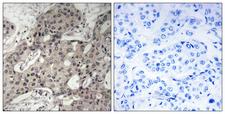 RPL3 / Ribosomal Protein L3 Antibody - Immunohistochemistry analysis of paraffin-embedded human breast carcinoma tissue, using RPL3 Antibody. The picture on the right is blocked with the synthesized peptide.