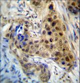 RPL3 / Ribosomal Protein L3 Antibody - RPL3 Antibody immunohistochemistry of formalin-fixed and paraffin-embedded human breast carcinoma followed by peroxidase-conjugated secondary antibody and DAB staining.