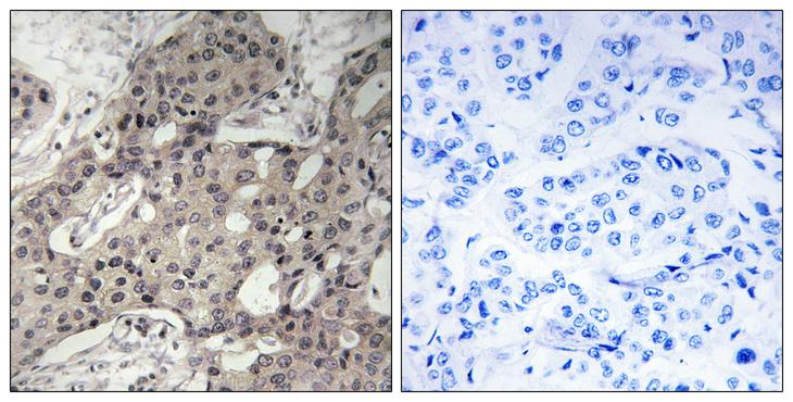 RPL3 / Ribosomal Protein L3 Antibody - Peptide - + Immunohistochemistry analysis of paraffin-embedded human breast carcinoma tissue using RPL3 antibody.