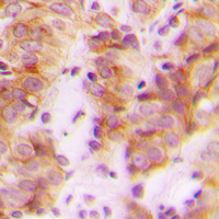 RPL30 / Ribosomal Protein L30 Antibody - Immunohistochemical analysis of RPL30 staining in human breast cancer formalin fixed paraffin embedded tissue section. The section was pre-treated using heat mediated antigen retrieval with sodium citrate buffer (pH 6.0). The section was then incubated with the antibody at room temperature and detected using an HRP conjugated compact polymer system. DAB was used as the chromogen. The section was then counterstained with hematoxylin and mounted with DPX.