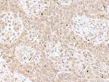 RPL35 / Ribosomal Protein L35 Antibody - Immunohistochemistry of paraffin-embedded Human ovarian cancer tissue  using RPL35 Polyclonal Antibody at dilution of 1:70(×200)