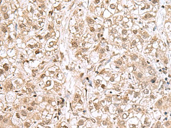 RPL35 / Ribosomal Protein L35 Antibody - Immunohistochemistry of paraffin-embedded Human liver cancer tissue  using RPL35 Polyclonal Antibody at dilution of 1:70(×200)