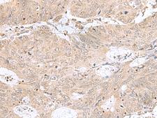RPL35 / Ribosomal Protein L35 Antibody - Immunohistochemistry of paraffin-embedded Human colorectal cancer tissue  using RPL35 Polyclonal Antibody at dilution of 1:50(×200)