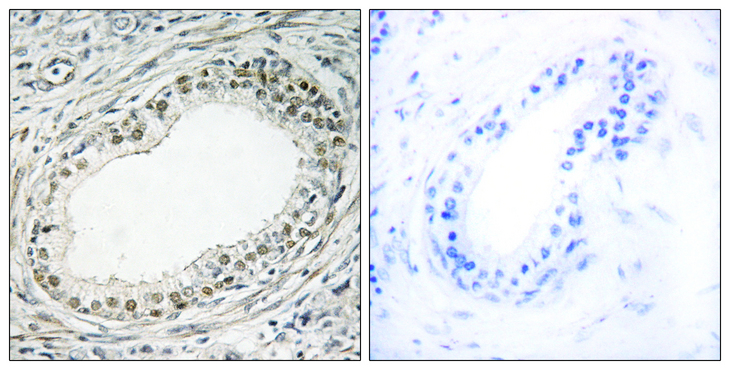 RPL36 / Ribosomal Protein L36 Antibody - Immunohistochemistry analysis of paraffin-embedded human prostate carcinoma tissue, using RPL36 Antibody. The picture on the right is blocked with the synthesized peptide.