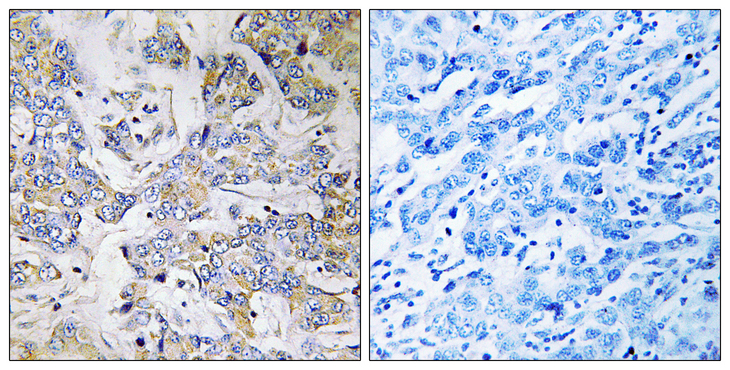 RPL37 / Ribosomal Protein L37 Antibody - Immunohistochemistry analysis of paraffin-embedded human breast carcinoma tissue, using RPL37 Antibody. The picture on the right is blocked with the synthesized peptide.