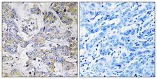 RPL37 / Ribosomal Protein L37 Antibody - Peptide - + Immunohistochemistry analysis of paraffin-embedded human breast carcinoma tissue using RPL37 antibody.
