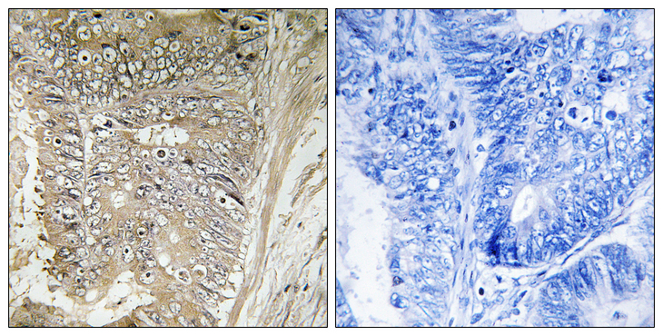 RPL37A Antibody - Immunohistochemistry analysis of paraffin-embedded human colon carcinoma tissue, using RPL37A Antibody. The picture on the right is blocked with the synthesized peptide.