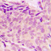 RPL37A Antibody - Immunohistochemical analysis of RPL37A staining in human breast cancer formalin fixed paraffin embedded tissue section. The section was pre-treated using heat mediated antigen retrieval with sodium citrate buffer (pH 6.0). The section was then incubated with the antibody at room temperature and detected using an HRP-conjugated compact polymer system. DAB was used as the chromogen. The section was then counterstained with hematoxylin and mounted with DPX.