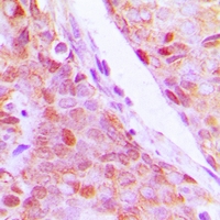RPL5 / Ribosomal Protein L5 Antibody - Immunohistochemical analysis of RPL5 staining in human breast cancer formalin fixed paraffin embedded tissue section. The section was pre-treated using heat mediated antigen retrieval with sodium citrate buffer (pH 6.0). The section was then incubated with the antibody at room temperature and detected with HRP and DAB as chromogen. The section was then counterstained with hematoxylin and mounted with DPX.