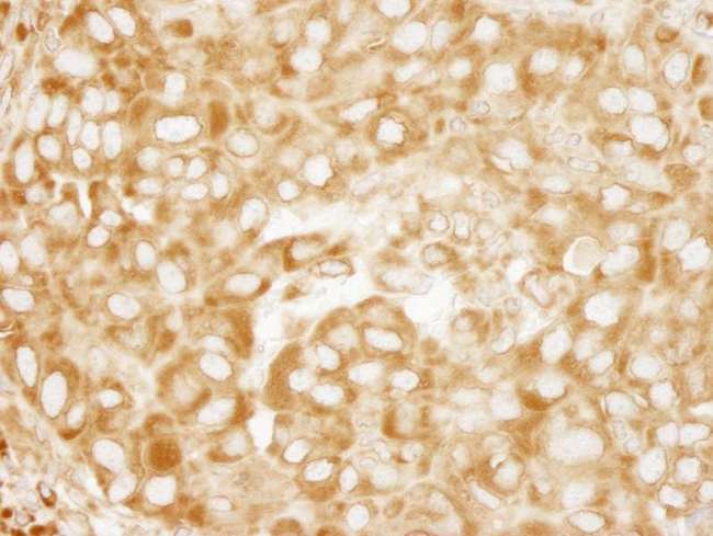 RPL7 / Ribosomal Protein L7 Antibody - Detection of Human RPL7 by Immunohistochemistry. Sample: FFPE section of human breast carcinoma. Antibody: Affinity purified rabbit anti-RPL7 used at a dilution of 1:100. Epitope Retrieval Buffer-High pH (IHC-101J) was substituted for Epitope Retrieval Buffer-Reduced pH.