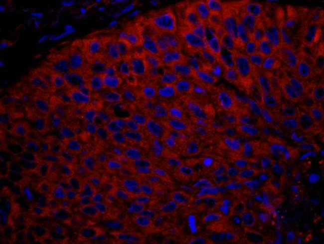 RPL7 / Ribosomal Protein L7 Antibody - Detection of Human RPL7 by Immunohistochemistry. Sample: FFPE section of human non-small cell lung cancer. Antibody: Affinity purified rabbit anti-RPL7 used at a dilution of 1:100. Detection: Red-fluorescent goat anti-rabbit IgG highly cross-adsorbed Antibody used at a dilution of 1:100.